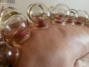 1/2 tími - viðgerð við vakumkoppum (Cupping)