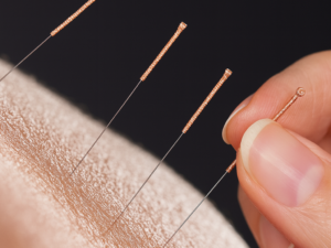 Eftirfylgjandi akupunkturviðgerðir